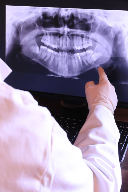 Best Emergency Wisdom Tooth Extraction in Nazareth College, NY